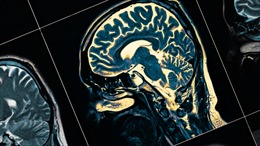 Bệnh nhân COVID-19 bị tổn thương não nghiêm trọng hơn người mắc Alzheimer
