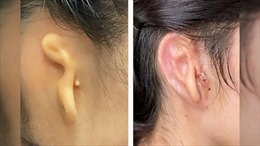 Người phụ nữ được cấy tai in 3D