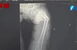 Người đàn ông 35 tuổi bị gãy xương cứng nhất cơ thể trong một cơn ho dữ dội