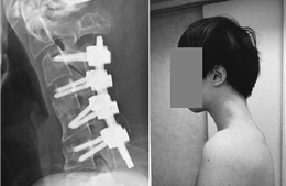 Thanh niên 25 tuổi mắc &#39;hội chứng cúi đầu&#39; hiếm gặp vì nhìn điện thoại quá nhiều