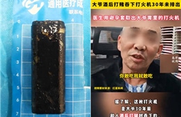 Người đàn ông Trung Quốc sống cùng bật lửa trong dạ dày suốt 30 năm