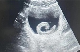 Người đàn ông phải nhập viện cấp cứu vì… đỉa sống trong bàng quang