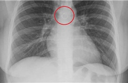 Ho kéo dài, người phụ nữ phát hiện khuyên mũi mắc kẹt trong phổi