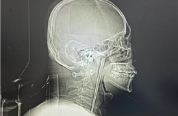 Người đàn ông sống tám năm với đũa kim loại dài 12cm mắc trong cổ họng