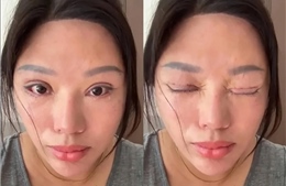 Sáu năm không nhắm được mắt khi ngủ sau khi cắt mí tại cơ sở 'chui'