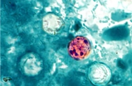 Ký sinh trùng Cyclospora là gì và vì sao đang gây lo ngại tại Mỹ?