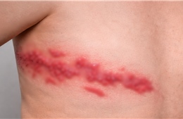 Cảnh báo nguy cơ gia tăng bệnh zona ở người có bệnh mạn tính