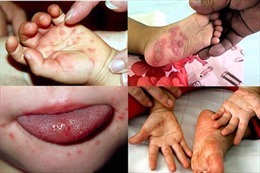 Bệnh nhi tay chân miệng ở Quảng Ngãi tăng đột biến, nằm tràn hành lang