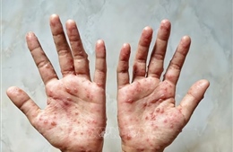 TP Hồ Chí Minh: Phát hiện thêm 6 ca bệnh đậu mùa khỉ trong 1 tuần