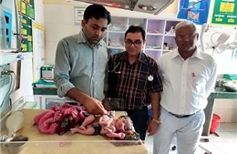 Bé gái sinh ra với 4 chân, 3 tay tại Ấn Độ