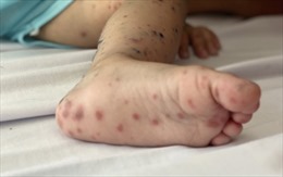 Bệnh nhi 5 tuổi tử vong nghi do mắc tay chân miệng