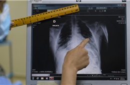 Nga ứng dụng AI trong chẩn đoán X-quang để xác định 54 bệnh