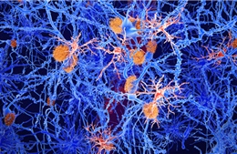 Phát hiện sự liên quan giữa tế bào miễn dịch ở não và bệnh Alzheimer