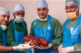 Phẫu thuật cắt bỏ quả thận khổng lồ nặng 7,4 kg của một bệnh nhân Ấn Độ