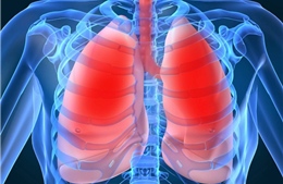 Nguy cơ lây nhiễm bệnh viêm phổi cấp chưa rõ nguyên nhân từ Trung Quốc