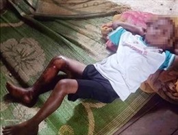 Đắk Lắk: Tạm giữ hình sự đối tượng trong vụ việc cháu bé 8 tuổi bị bỏng xăng