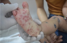 Bệnh tay chân miệng có xu hướng gia tăng