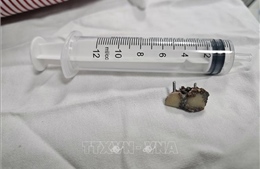 Nội soi lấy thành công 2 răng giả tồn tại trong phổi bệnh nhân hơn 20 năm