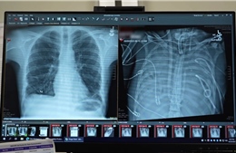 Đột phá phổi nhân tạo cứu sống bệnh nhân chờ ghép tạng