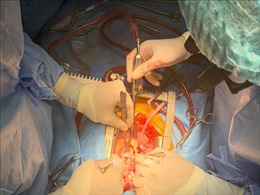 Phẫu thuật lấy khối u gan khổng lồ kịp thời cứu sống người bệnh
