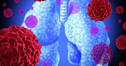 Phát hiện, điều trị kịp thời bệnh nấm phổi để giảm nguy cơ tử vong