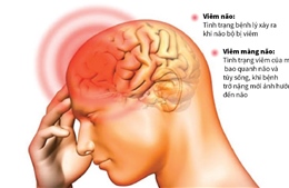 Phòng tránh bệnh viêm não và viêm màng não