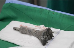 Thay xương chày cho bệnh nhân ung thư xương bằng mảnh ghép 3D hợp kim Titanium