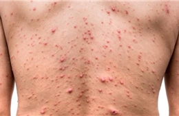 Đảo Sơn Ca cấp cứu một ngư dân bị bệnh thủy đậu giai đoạn toàn phát