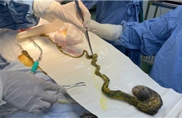 Cảnh báo bệnh lý nguy hiểm do hành vi ăn tóc ở trẻ em