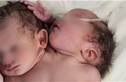 Trường hợp hy hữu em bé 2 đầu và 3 tay sinh ra tại Ấn Độ
