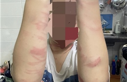 TP Hồ Chí Minh: Điều tra vụ thiếu nữ 17 tuổi bị mẹ đánh gây nhiều thương tích