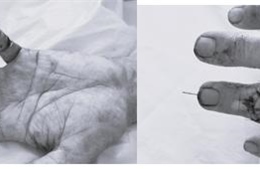 Nối thành công ngón tay đứt lìa trong 6 giờ vàng cho bệnh nhân 47 tuổi