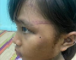 Xác minh việc bé gái nghi bị bạo hành ở Bình Phước