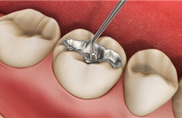 Nhiều nước kêu gọi cấm vật liệu trám răng chứa thủy ngân trước năm 2030