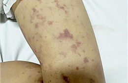 Phát hiện 2 trường hợp mắc viêm não mô cầu, Đắk Lắk triển khai gấp công tác truy vết