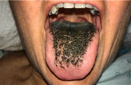 Lý giải hiện tượng lưỡi ‘mọc lông đen’