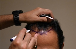 Cấy tóc gây chết chóc tại Ấn Độ