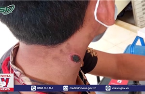 Bệnh than là bệnh truyền nhiễm cấp tính nguy hiểm lây từ động vật sang người