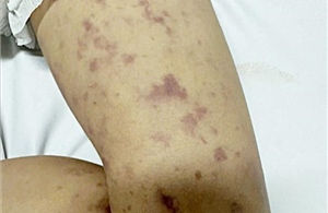 Phát hiện 2 trường hợp mắc viêm não mô cầu, Đắk Lắk triển khai gấp công tác truy vết