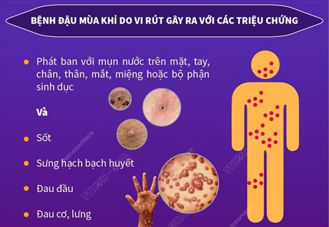 Khuyến cáo phòng chống bệnh đậu mùa khỉ với khách nhập cảnh Việt Nam - Bài 1
