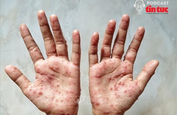 Bệnh đậu mùa khỉ liệu có lây lan mạnh?