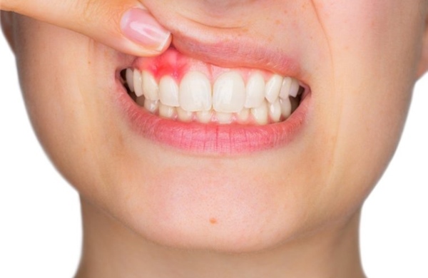 Bệnh nha chu âm thầm đe dọa sức khỏe răng miệng