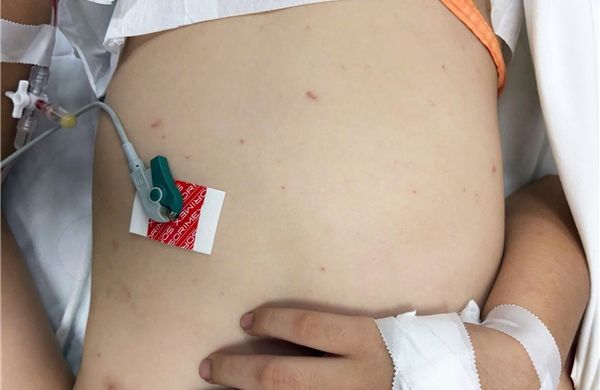 Cảnh báo gia tăng bệnh não mô cầu ở khu vực phía Nam