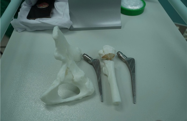 Ứng dụng in 3D phẫu thuật thành công ca loạn sản khớp háng hiếm gặp