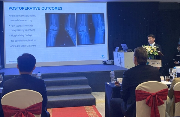 Nhiều tiến bộ trong kỹ thuật thay khớp gối, hướng tới cá thể hóa điều trị và phục hồi sớm