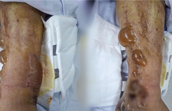 Bác sĩ cảnh báo tự đắp thuốc lá chữa chấn thương có thể gây nhiễm trùng nặng