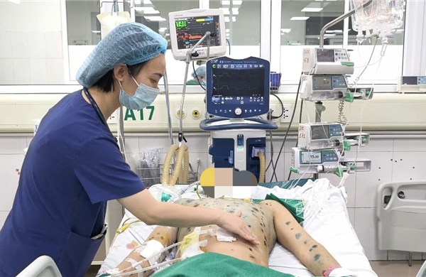 Gia tăng ca mắc thủy đậu, cảnh báo nguy cơ biến chứng nặng