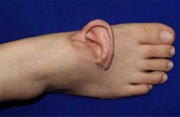 Người phụ nữ mang chiếc tai đứt rời được gắn tạm ở bàn chân suốt 5 tháng