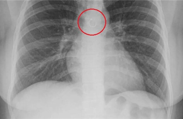 Ho kéo dài, người phụ nữ phát hiện khuyên mũi mắc kẹt trong phổi