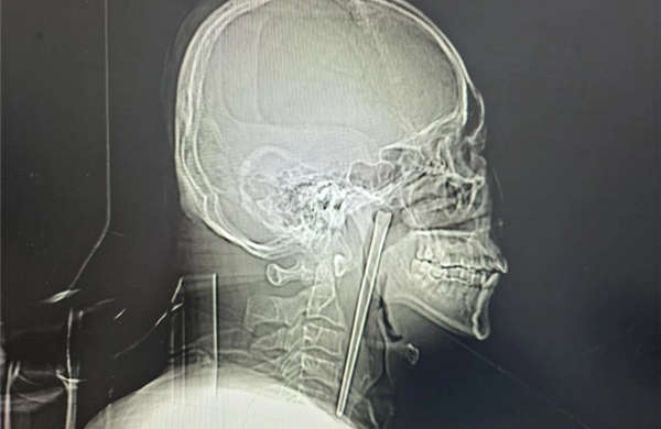 Người đàn ông sống tám năm với đũa kim loại dài 12cm mắc trong cổ họng